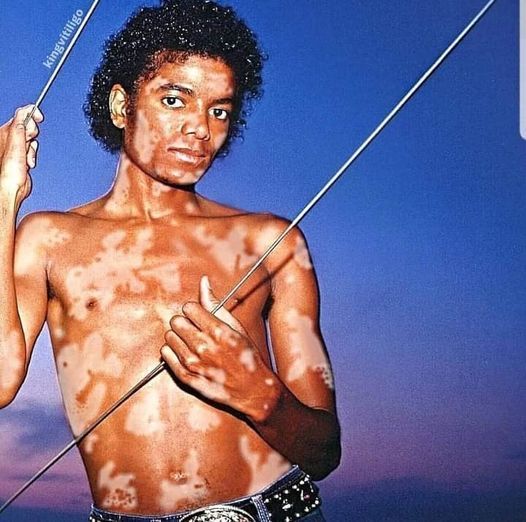 Entenda o processo real da transforma&ccedil;&atilde;o de Michael Jackson, desde o acidente de 1984 at&eacute; o diagn&oacute;stico de vitiligo e as cirurgias no rosto.