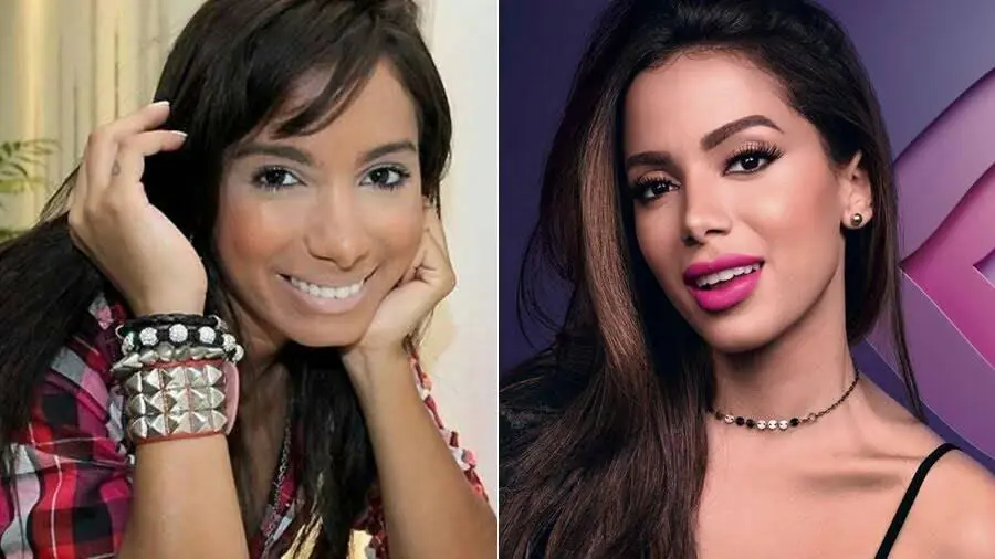 Anitta hoje: a verdade por tr&aacute;s das sucessivas pl&aacute;sticas