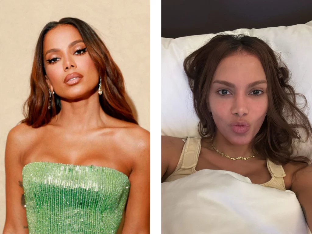 Anitta hoje: a verdade por tr&aacute;s das sucessivas pl&aacute;sticas