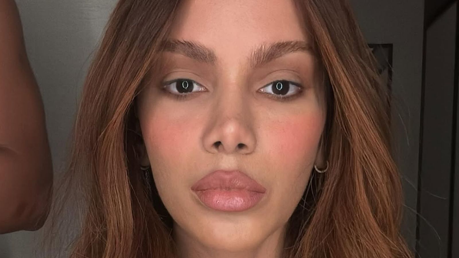 Anitta hoje: a verdade por tr&aacute;s das sucessivas pl&aacute;sticas