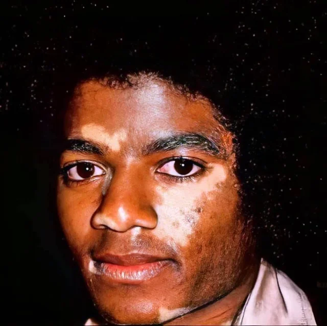 Entenda o processo real da transforma&ccedil;&atilde;o de Michael Jackson, desde o acidente de 1984 at&eacute; o diagn&oacute;stico de vitiligo e as cirurgias no rosto.