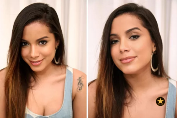 Anitta hoje: a verdade por trás das sucessivas plásticas